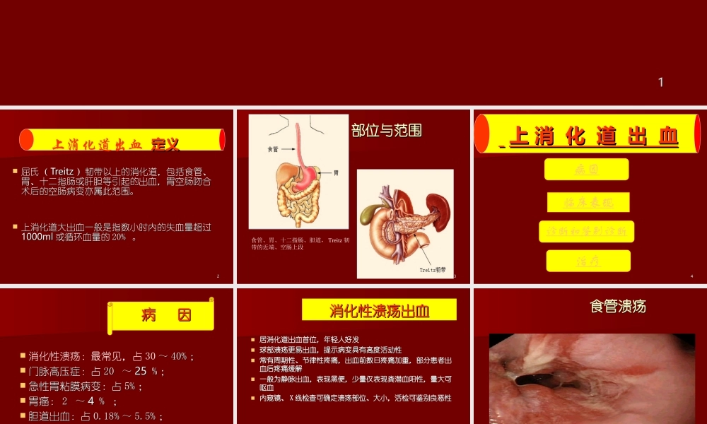 上消化道出血33.ppt