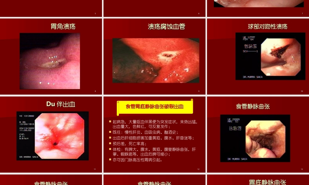 上消化道出血33.ppt