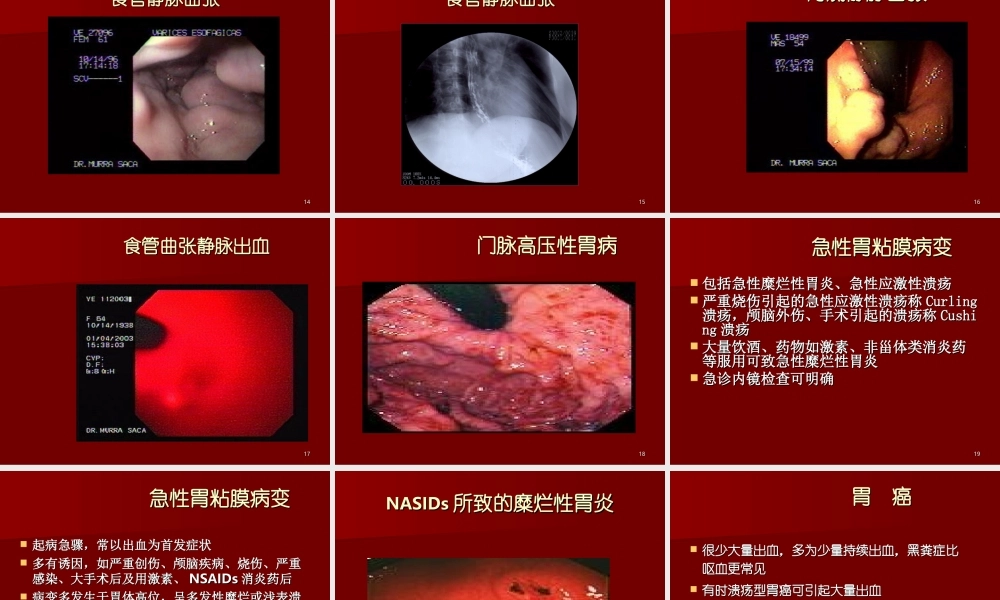 上消化道出血33.ppt