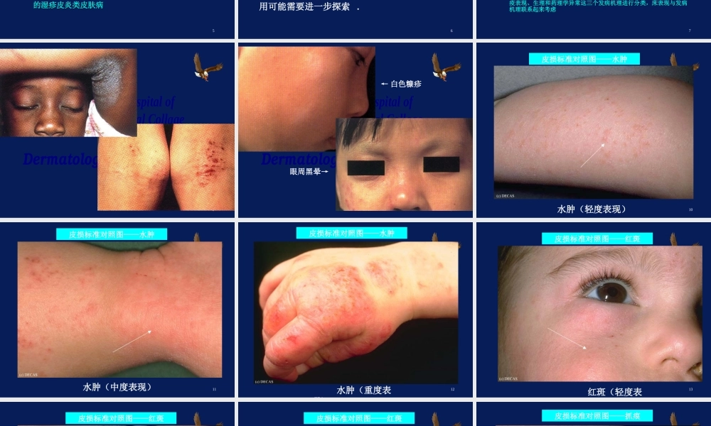 特应性皮炎AD的中西医诊疗进展.ppt