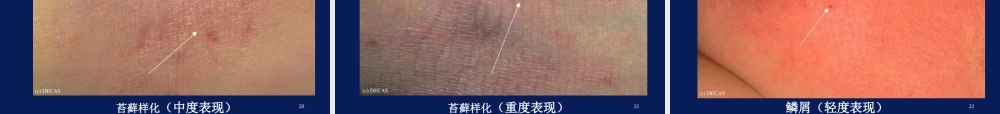 特应性皮炎AD的中西医诊疗进展.ppt