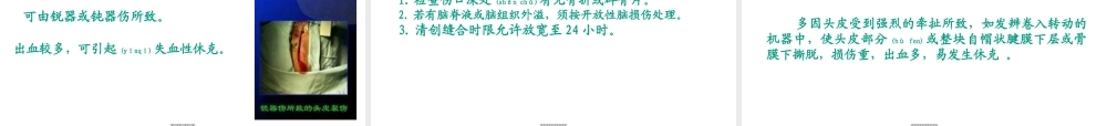 2022年医学专题—《颅脑损伤1》-PPT文档(1).ppt