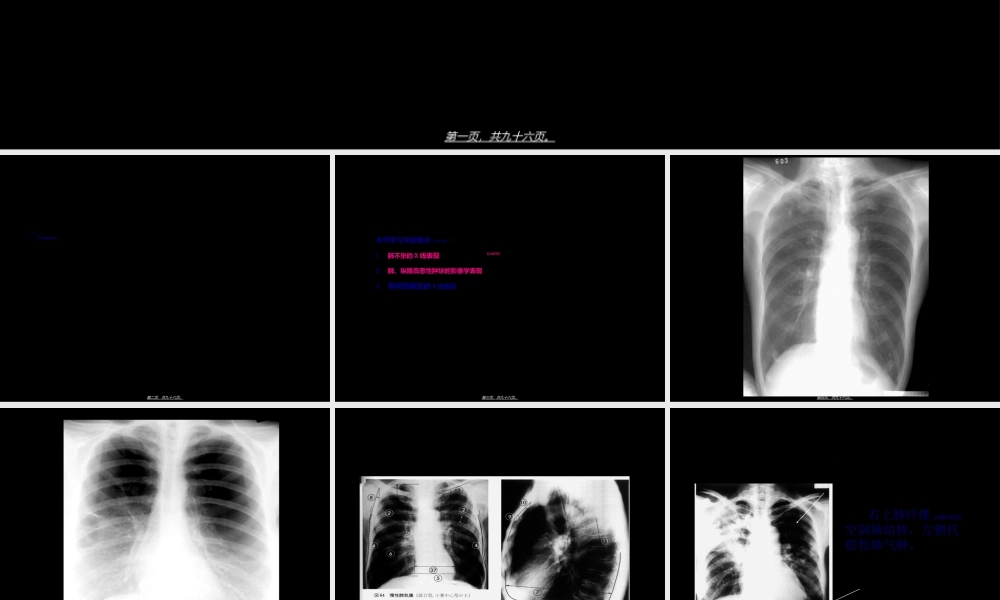 2022年医学专题—呼吸系统基本病变影像学表现见习幻灯.ppt