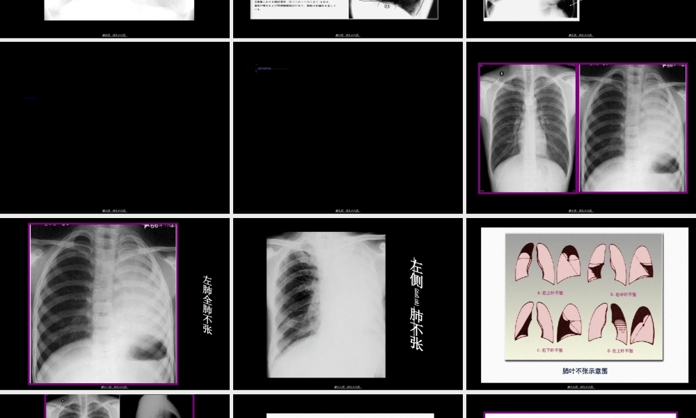 2022年医学专题—呼吸系统基本病变影像学表现见习幻灯.ppt