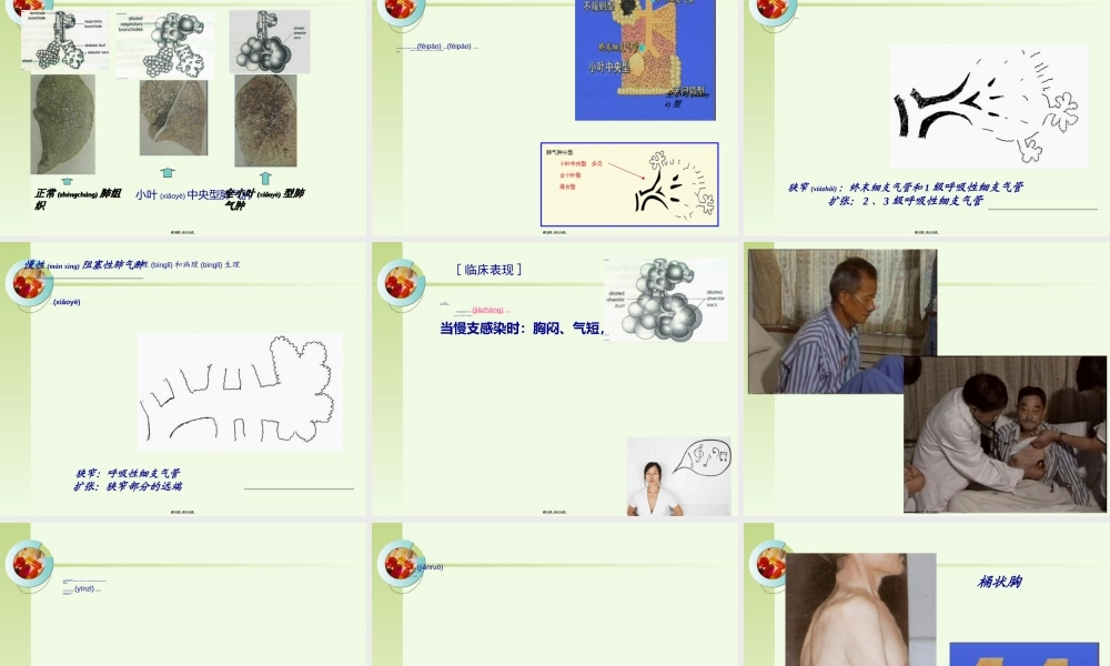 2022年医学专题—第四节二、-阻塞性肺气肿、肺源性心脏病.ppt