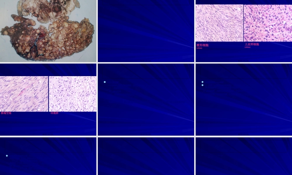 2022年医学专题—胃肠间质瘤.ppt
