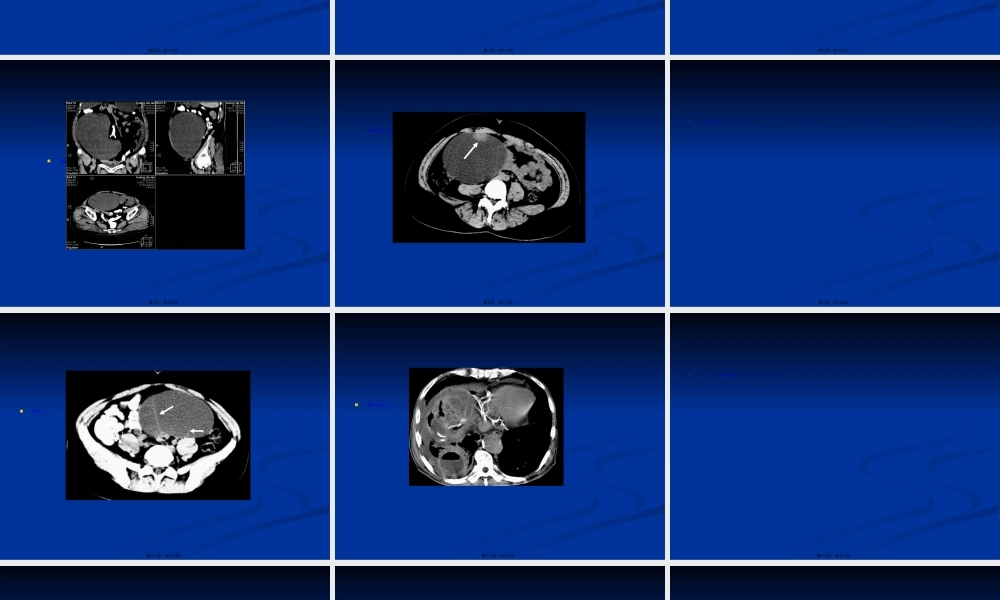 2022年医学专题—卵巢囊性病变的CT表现.ppt