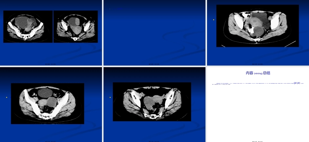 2022年医学专题—卵巢囊性病变的CT表现.ppt