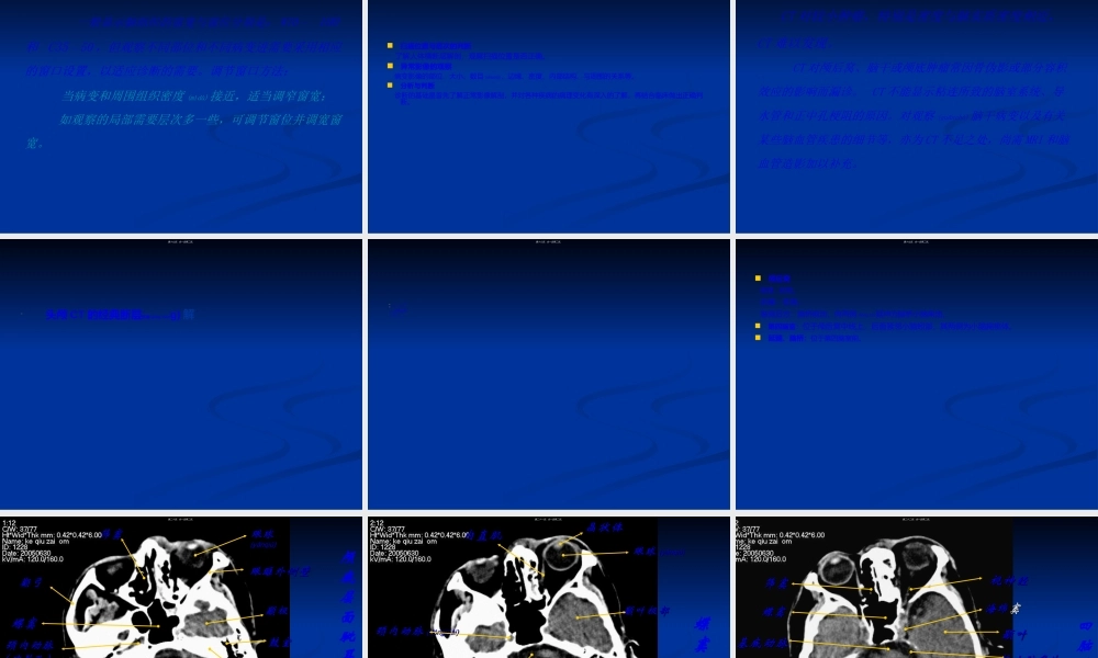 2022年医学专题—头颅CT读片.ppt