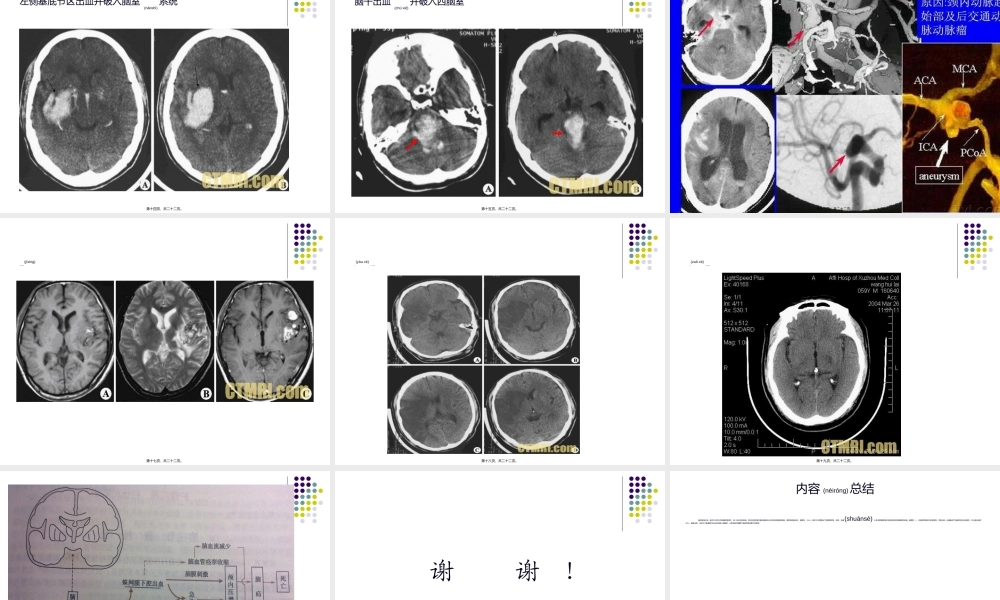 2022年医学专题—脑血管病的分类.ppt