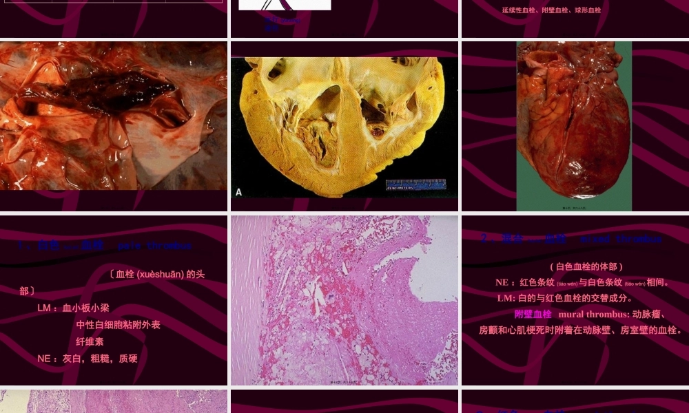 2022年医学专题—4局部血液循环障碍(二)(1).ppt