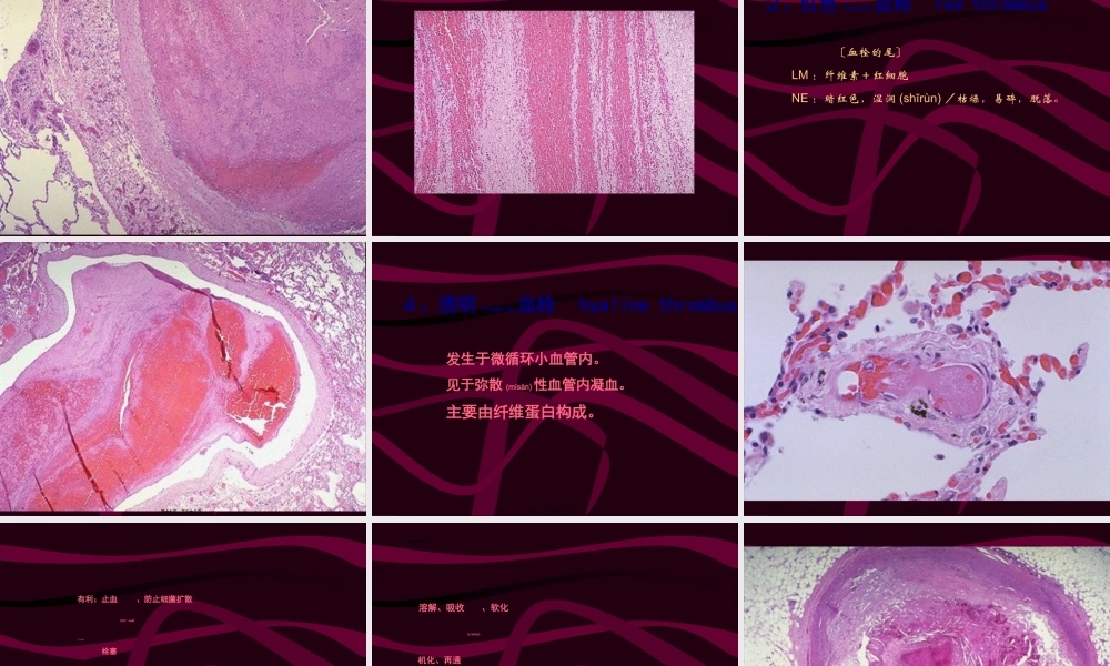 2022年医学专题—4局部血液循环障碍(二)(1).ppt