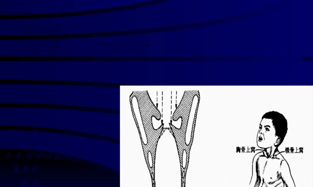 2022年医学专题—喉阻塞(1).ppt