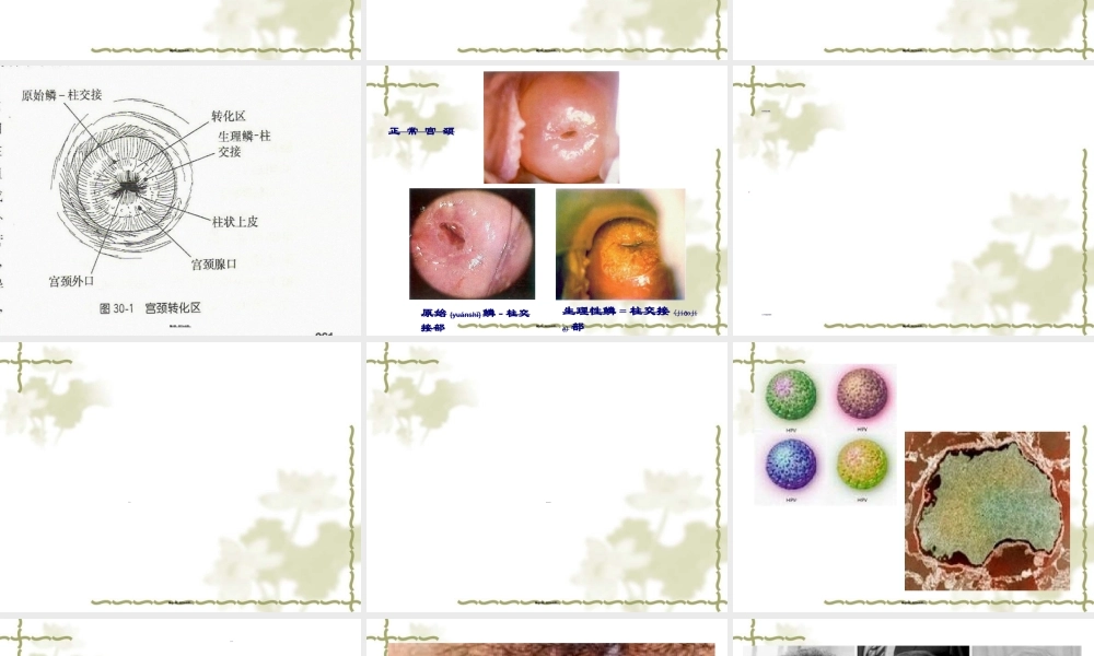 2022年医学专题—宫颈癌-PPT模板(1).ppt