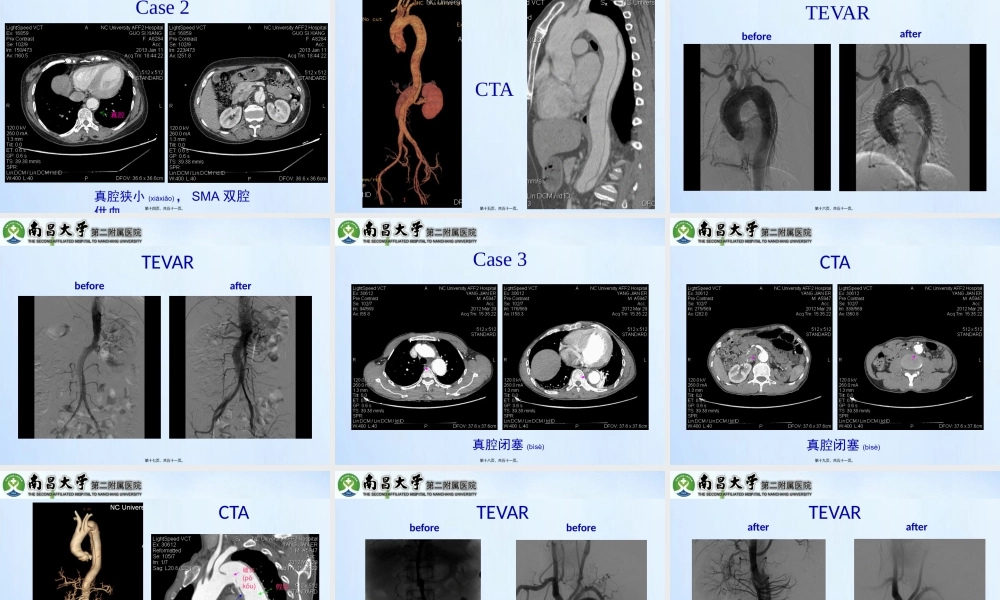 2022年医学专题—急性Stanford-B型AD并灌注不良的处理(1).pptx