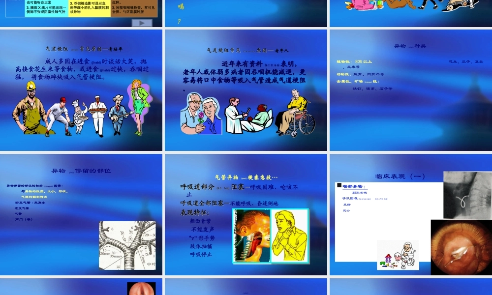 2022年医学专题—急性呼吸道梗阻的急救(1).ppt