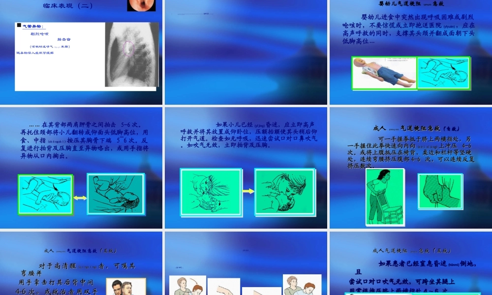 2022年医学专题—急性呼吸道梗阻的急救(1).ppt