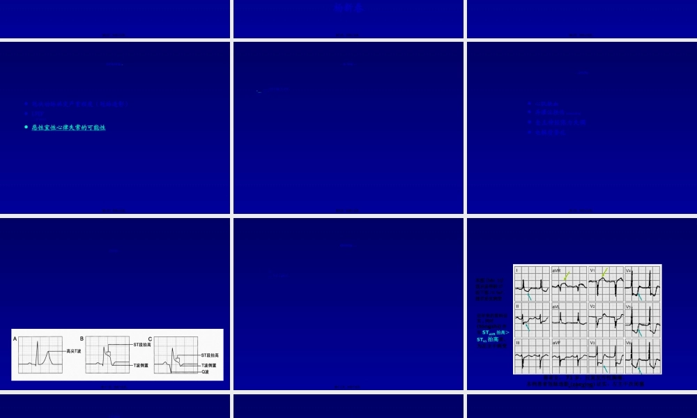 2022年医学专题—急性心肌梗死猝死的心电图(1).ppt