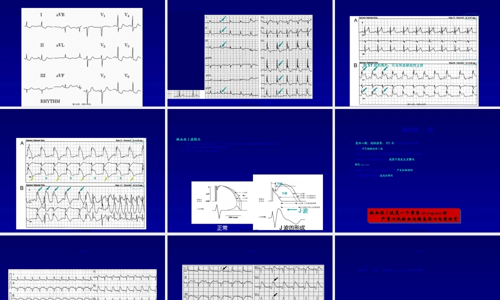 2022年医学专题—急性心肌梗死猝死的心电图(1).ppt