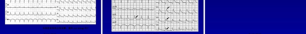 2022年医学专题—急性心肌梗死猝死的心电图(1).ppt
