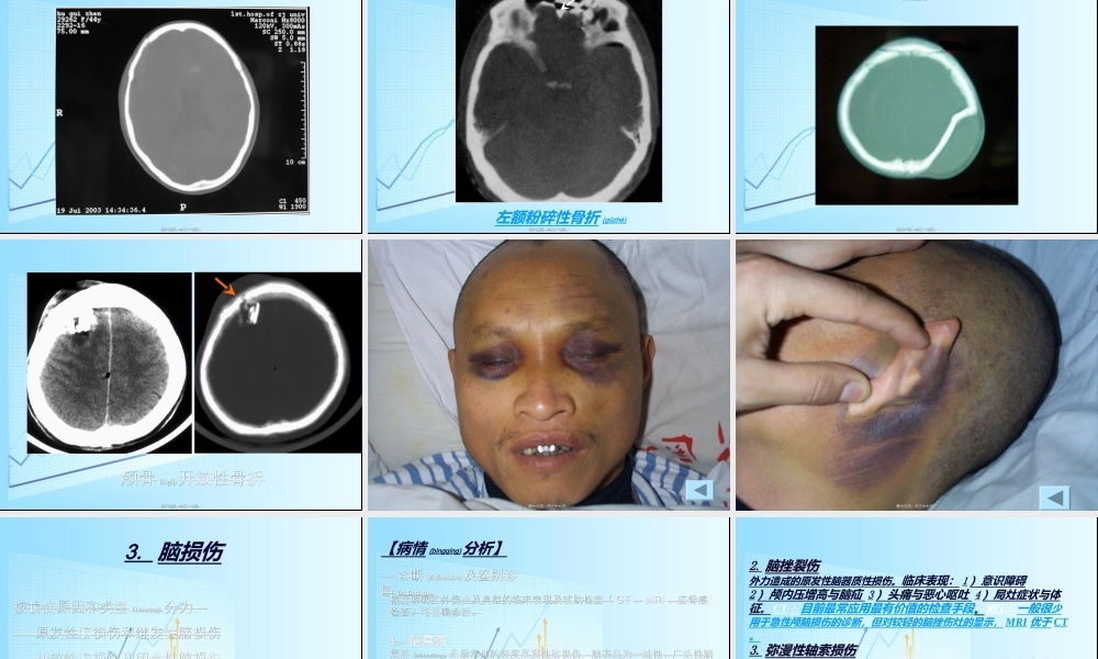 2022年医学专题—急性颅脑损伤概要(1).ppt