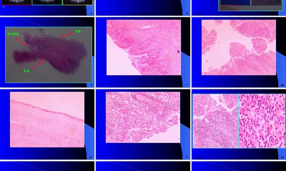2022年医学专题—慢性化脓性胆囊炎(1).ppt