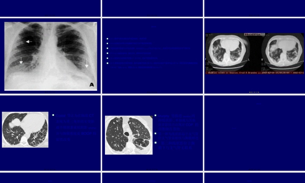2022年医学专题—机化性肺炎(1).ppt