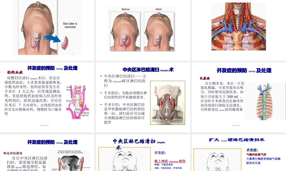 2022年医学专题—甲状腺切除术.ppt(1).ppt