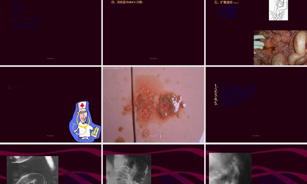 2022年医学专题—结肠癌(Carcinoma-of-Colon)(1).ppt