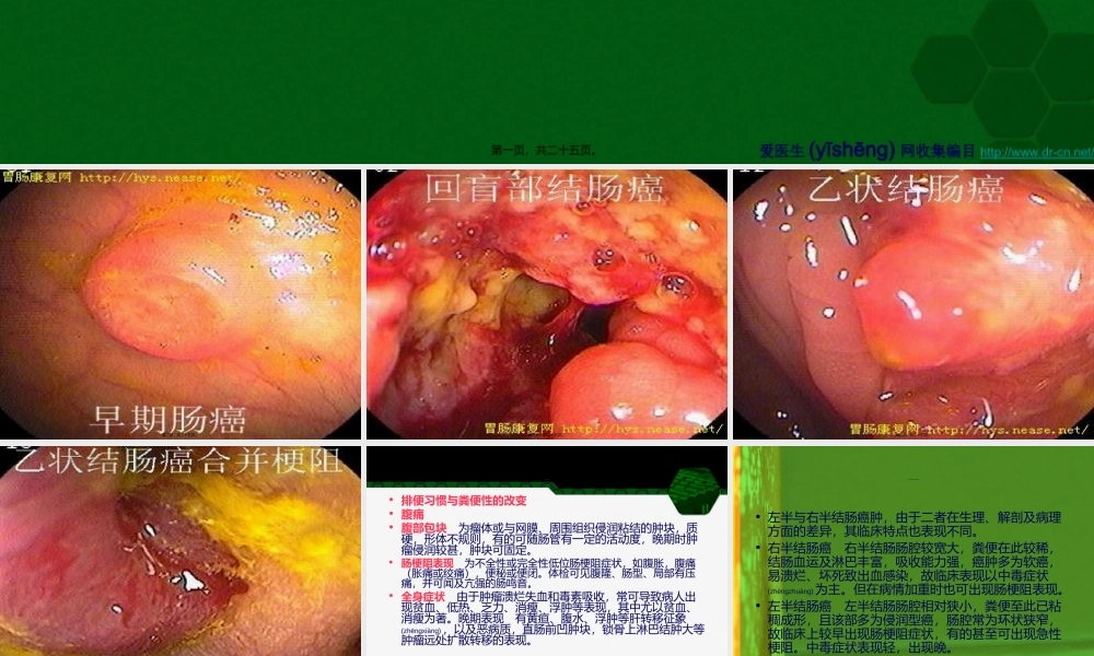 2022年医学专题—结肠癌结肠癌摘要(1).ppt