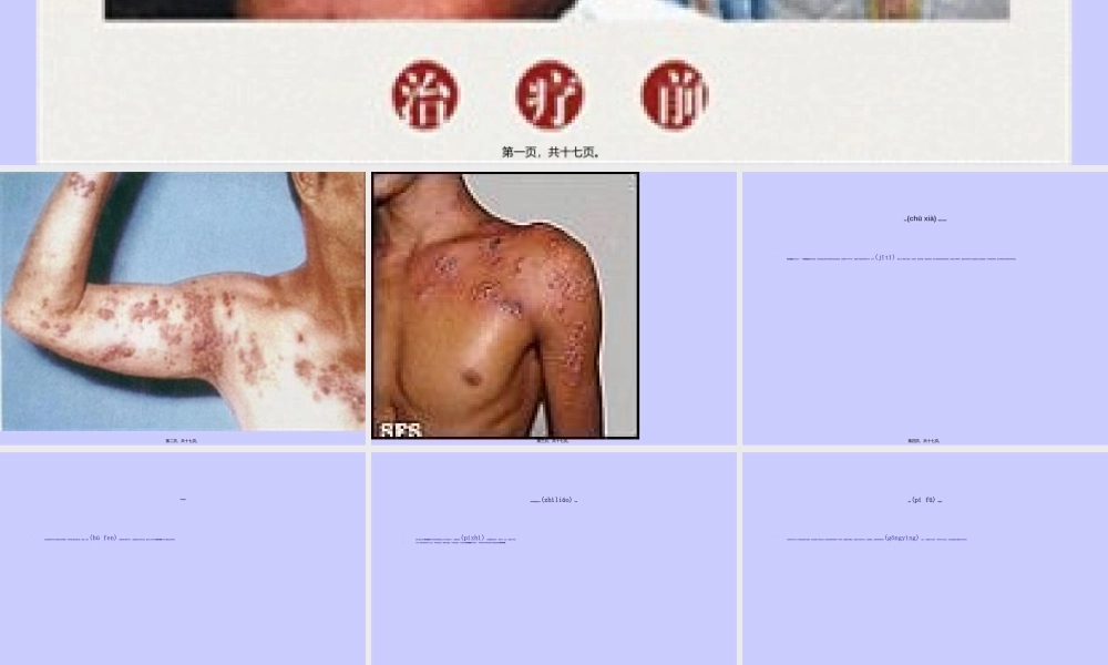 2022年医学专题—老年皮肤瘙痒症(1).ppt