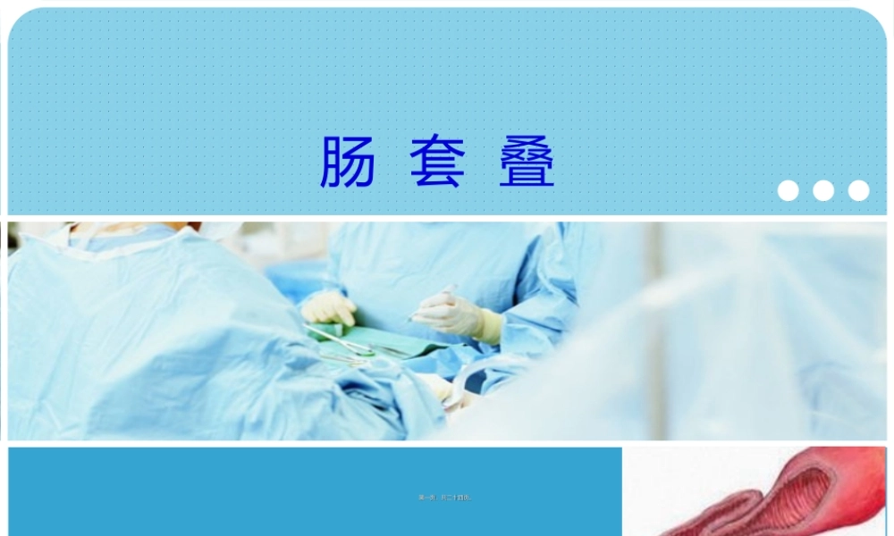 2022年医学专题—肠套叠(1).ppt