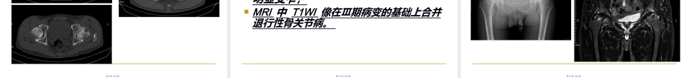 2022年医学专题—股骨头缺血性坏死(1).ppt