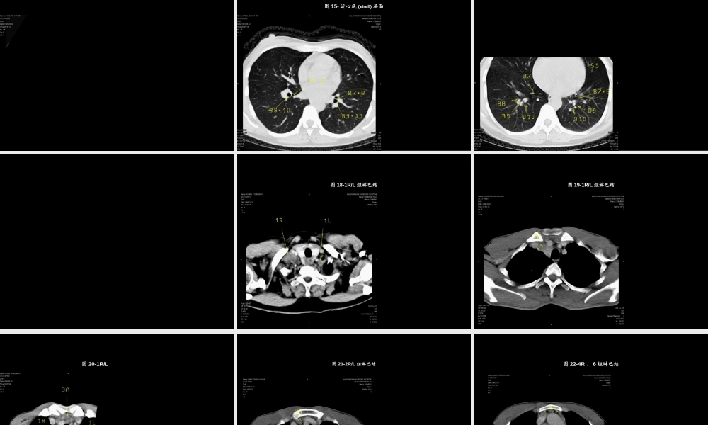 2022年医学专题—肺段ct(1).ppt