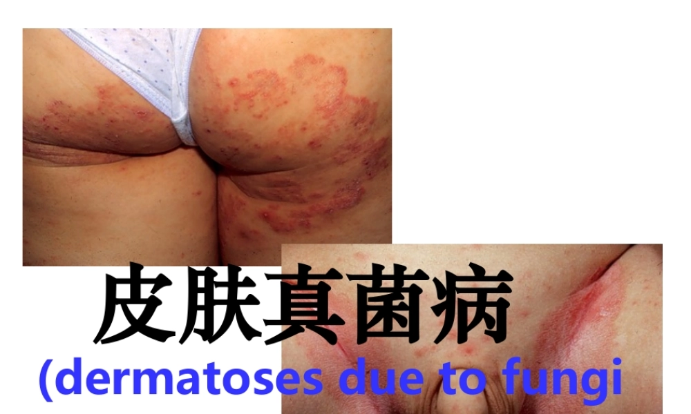 4真菌性皮肤病(1).ppt
