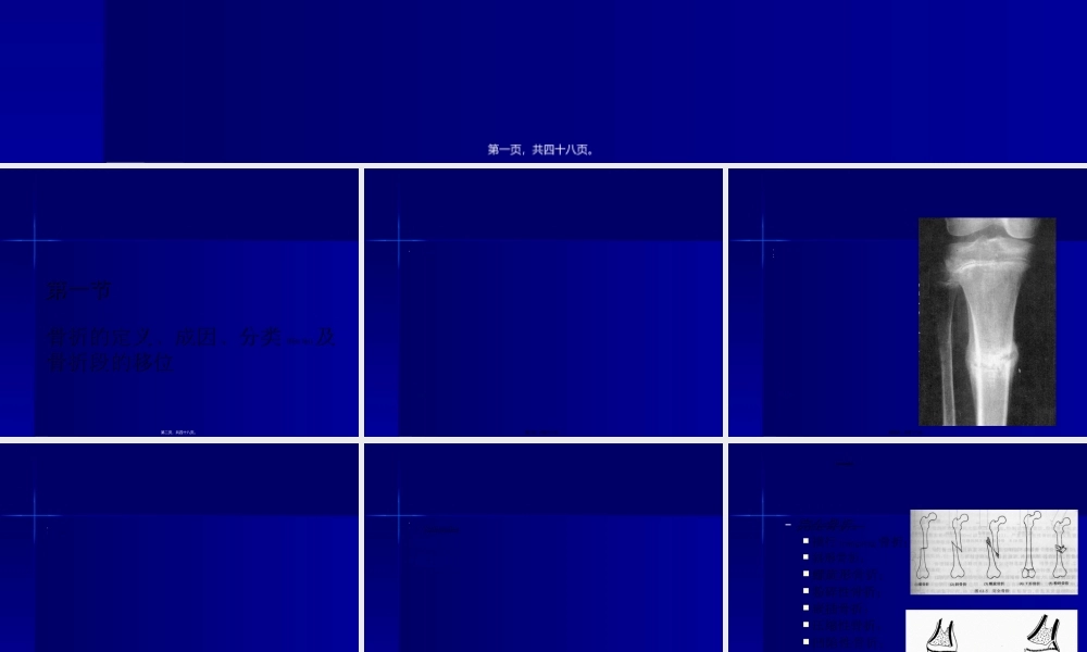 2022年医学专题—第62篇-骨折浅论(1).ppt