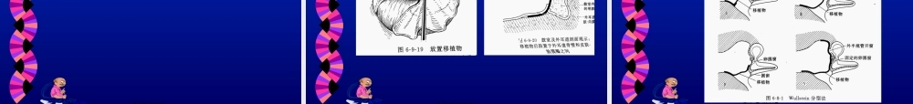2022年医学专题—慢性中耳炎、耳聋、眩晕(1).ppt