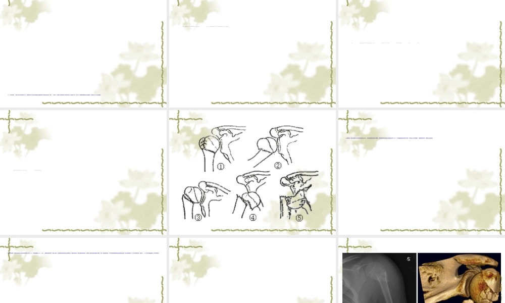 2022年医学专题—股骨外科颈骨折演示(1).ppt