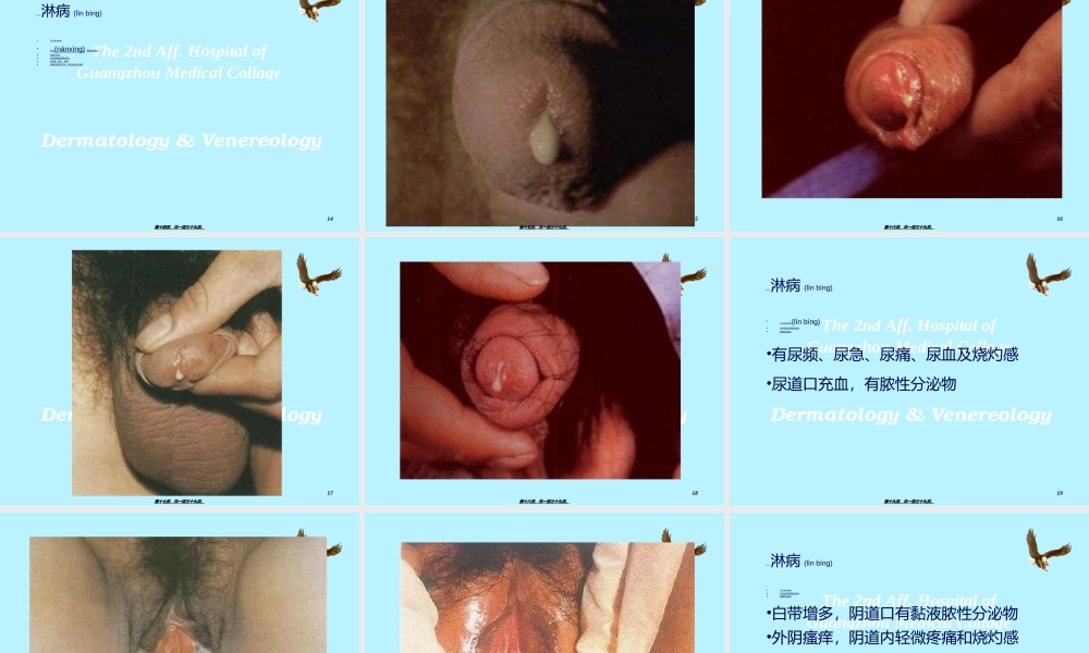 2022年医学专题—淋病与非淋菌性尿道炎(1).ppt