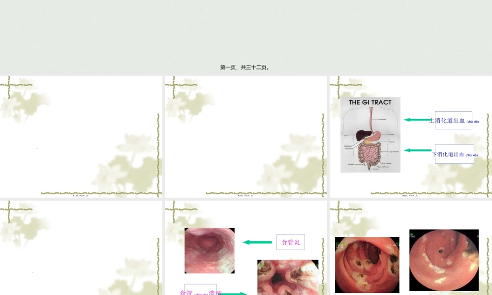 2022年医学专题—上消化道大出血的(1).ppt