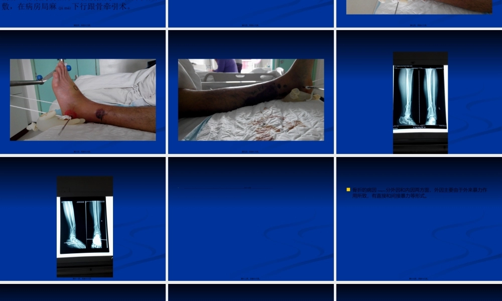 2022年医学专题—业务查房-(胫腓骨骨折)(1).ppt