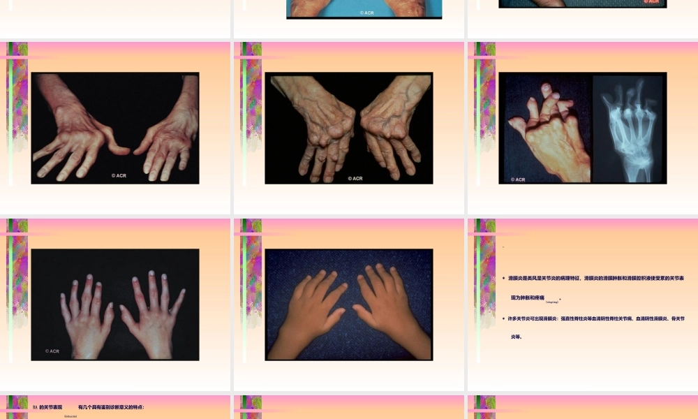 2022年医学专题—中山医科大学类风湿关节炎(1).ppt