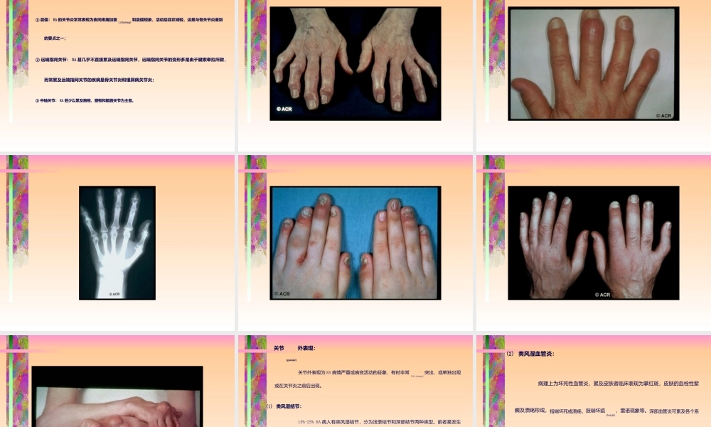 2022年医学专题—中山医科大学类风湿关节炎(1).ppt