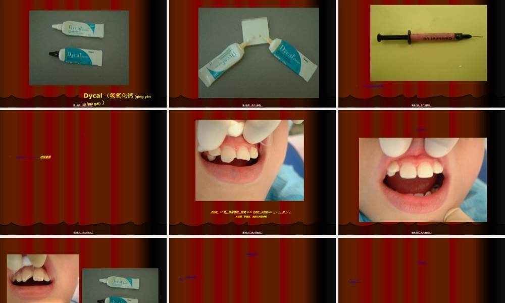 2022年医学专题—年轻恒牙外伤.ppt(1).ppt