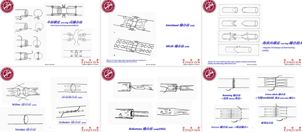 2022年医学专题—手外科肌腱缝合(1).ppt