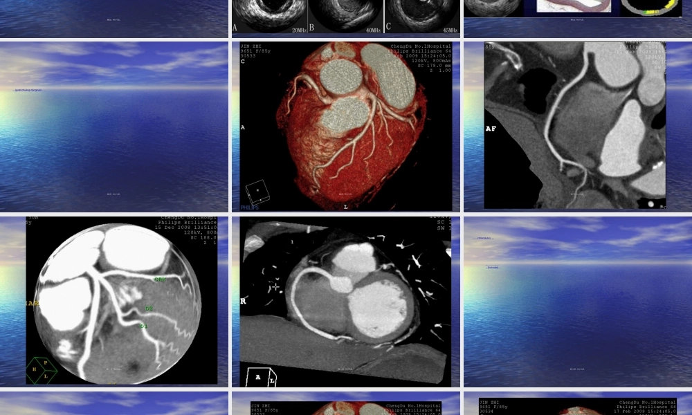 2022年医学专题—排螺旋CT的冠状动脉成像(1).ppt