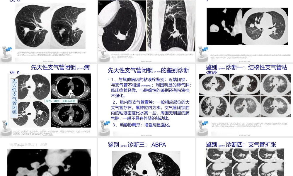 2022年医学专题—支气管粘液栓塞(1).ppt