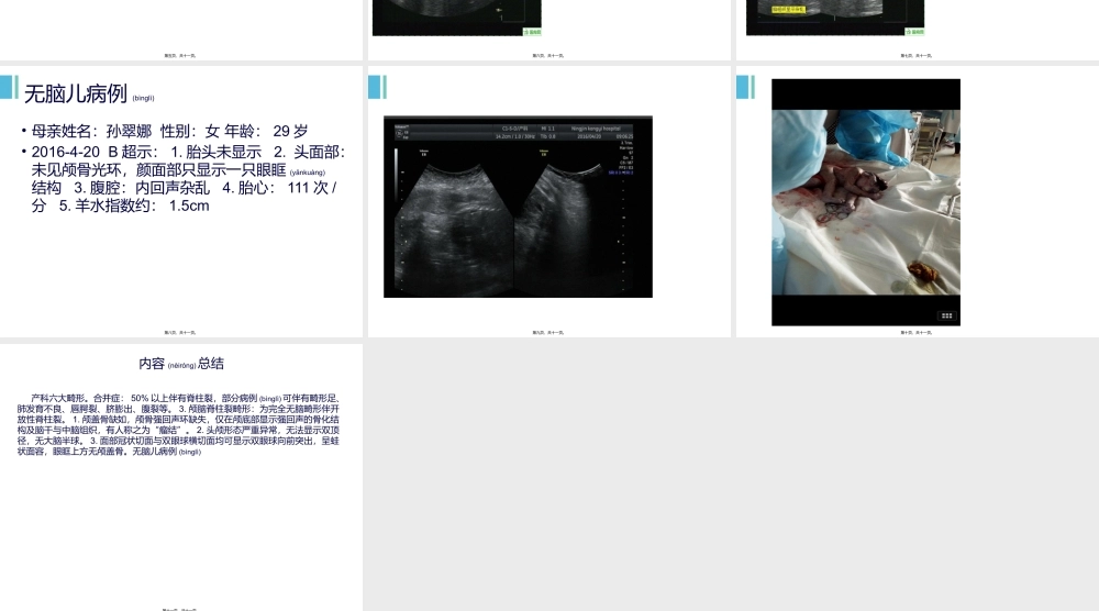 2022年医学专题—无脑儿(1).ppt
