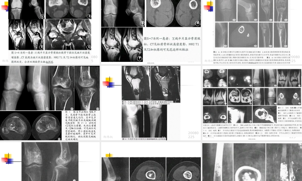 2022年医学专题—浅论骨梗死080225(1).ppt