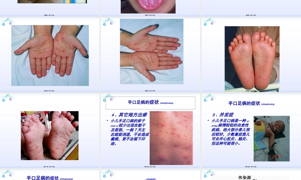 2022年医学专题—浅谈手足口病(1).ppt